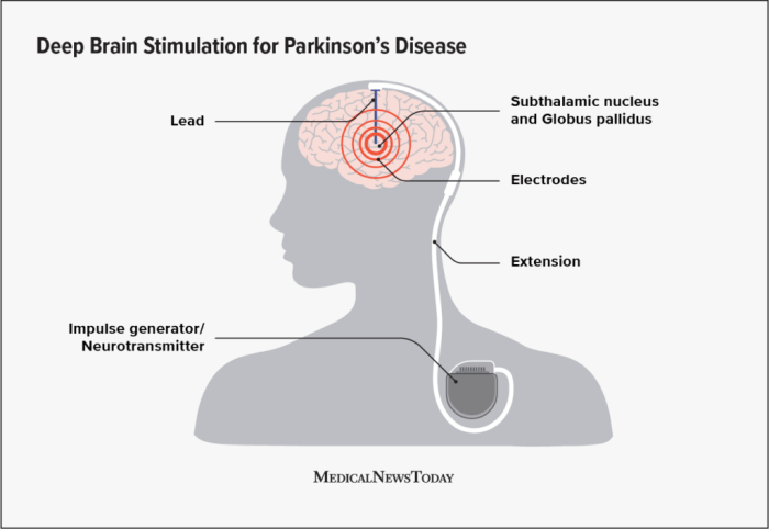 Deep brain stimulation (DBS) for Parkinson’s: What to expect Deep brain stimulation parkinsons disease